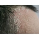 Psoriasis